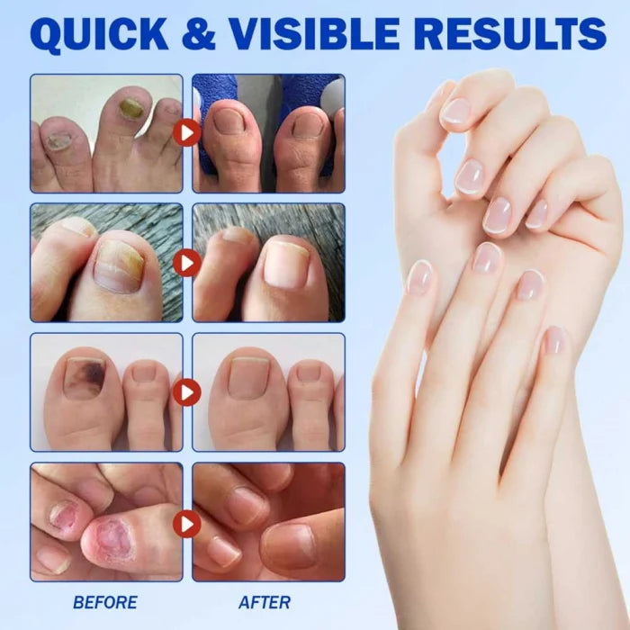 21 Plasturi NailHeal™ Pentru Ciuperca Unghiei